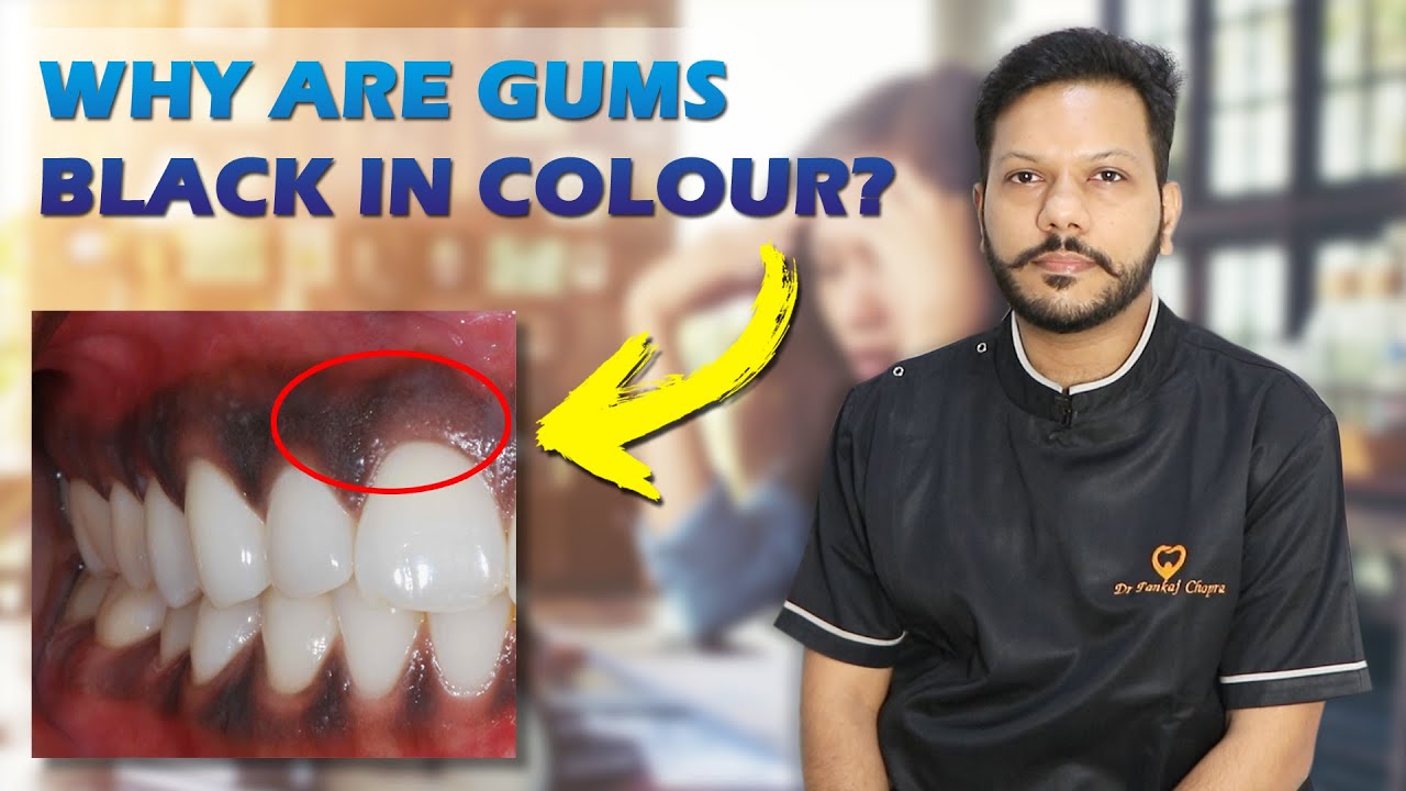 Why Are Gums Black In Colour? | Dr. Pankaj Chopra