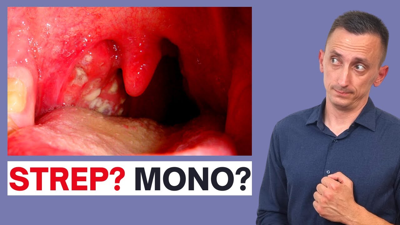 A Clinical Approach to a Sore Throat