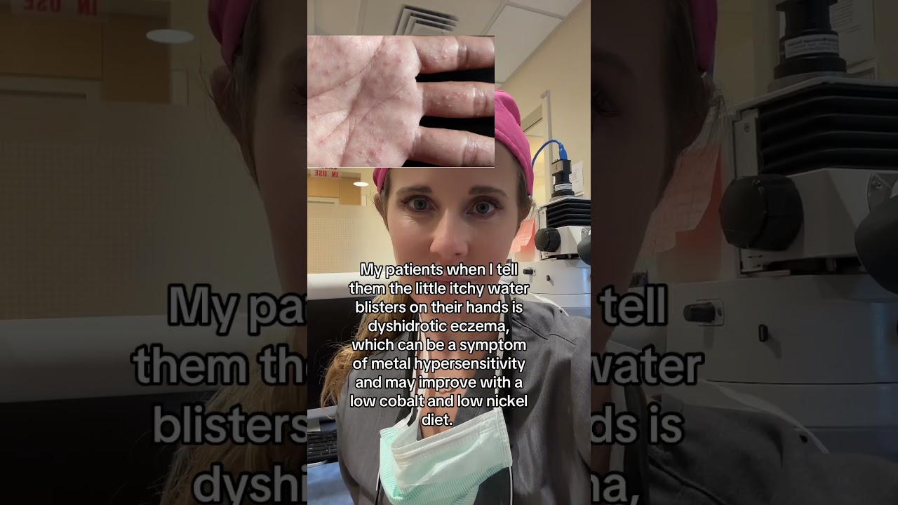 Comment if you have dyshidrotic eczema and I’ll share the diet I give to my patients.