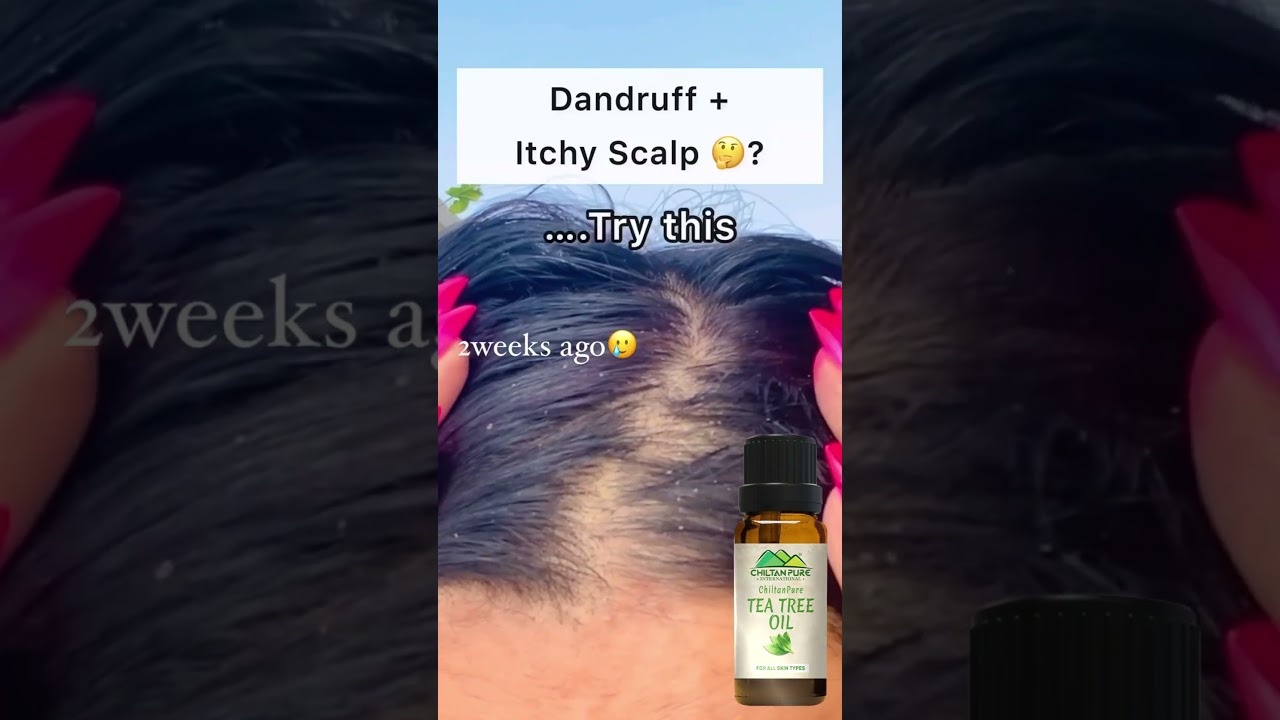 Tea Tree Oil |  Anti-Dandruff Essential Oil | Solution for Itchy & Flaky Scalp | ChiltanPure