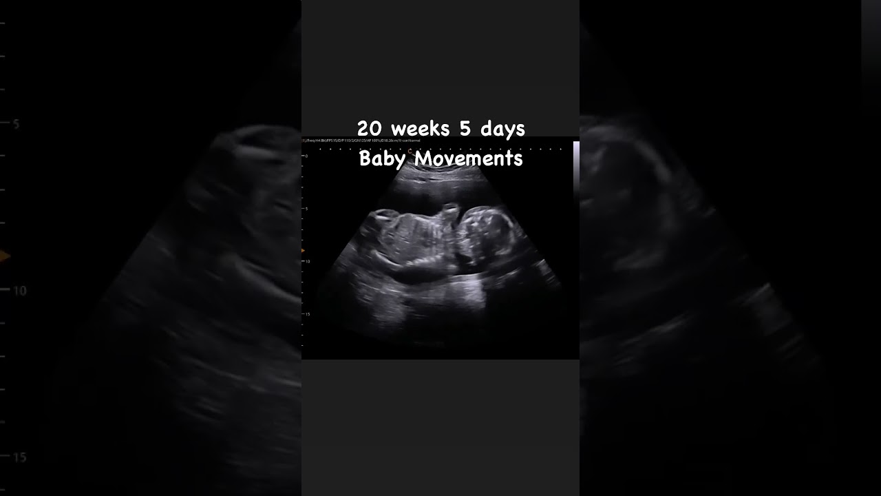 20 weeks 5 days Baby Movements 🥰 #jerbearimaging #athome #ultrasound #babymovement #babylife #sono