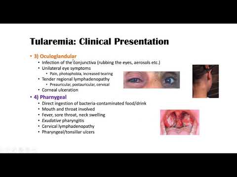 Tularemia Disease