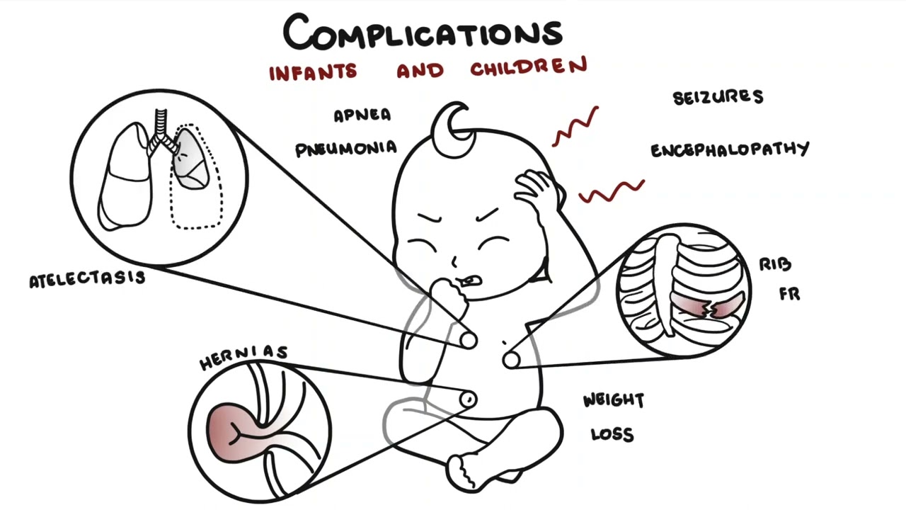 What is Pertussis and whooping cough? - Bordetella pertussis symptoms, pathophysiology and treatment