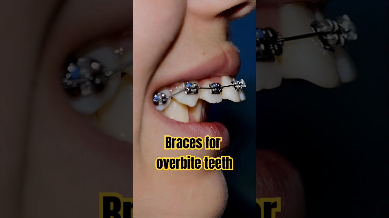 Braces for overbite teeth transformation #braces #orthodontist #dentist