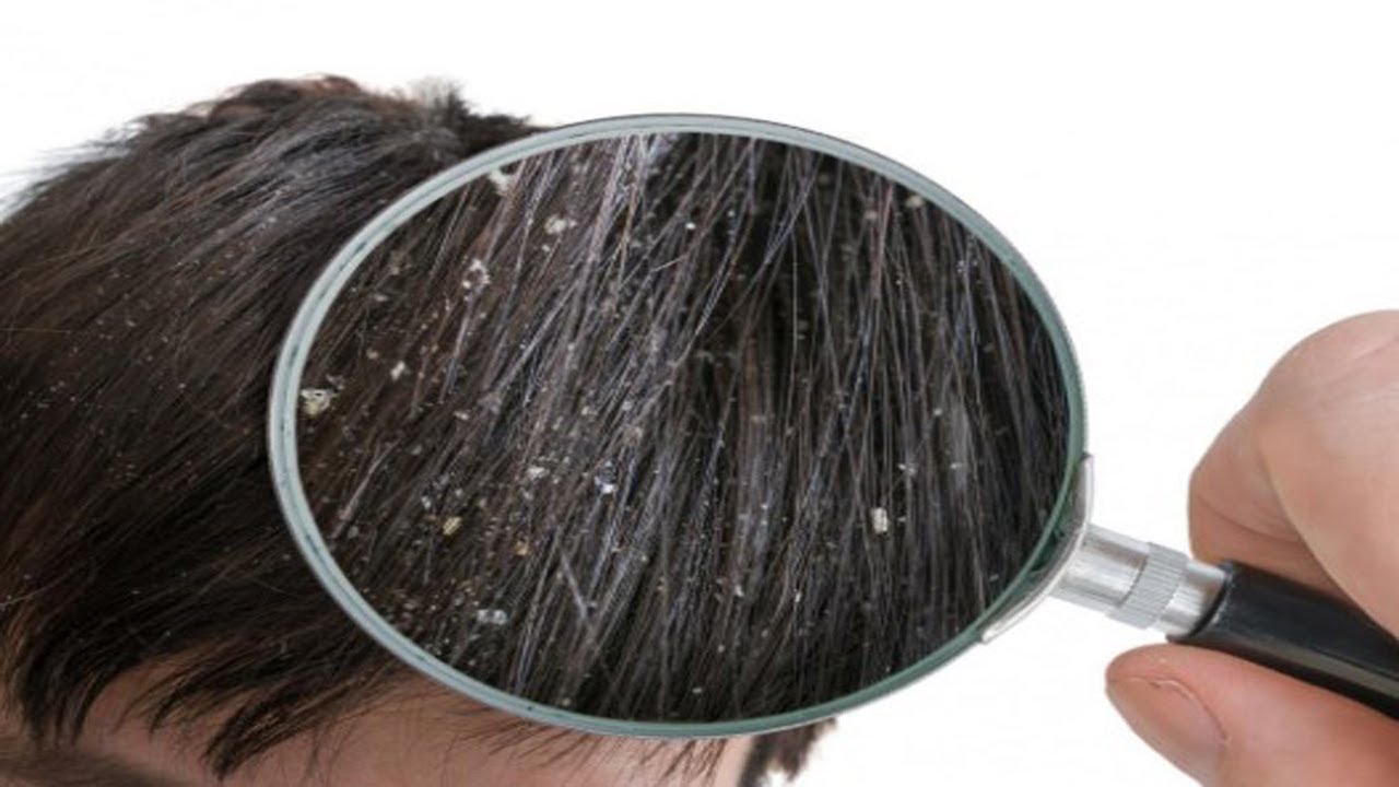 Tea Tree Oil Benefits For Hair - How to Use Tea Tree Oil for Hair Growth