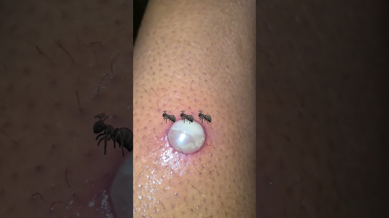 #viral #viralvideo #shortvideo #fireants #ants #bite #shorts