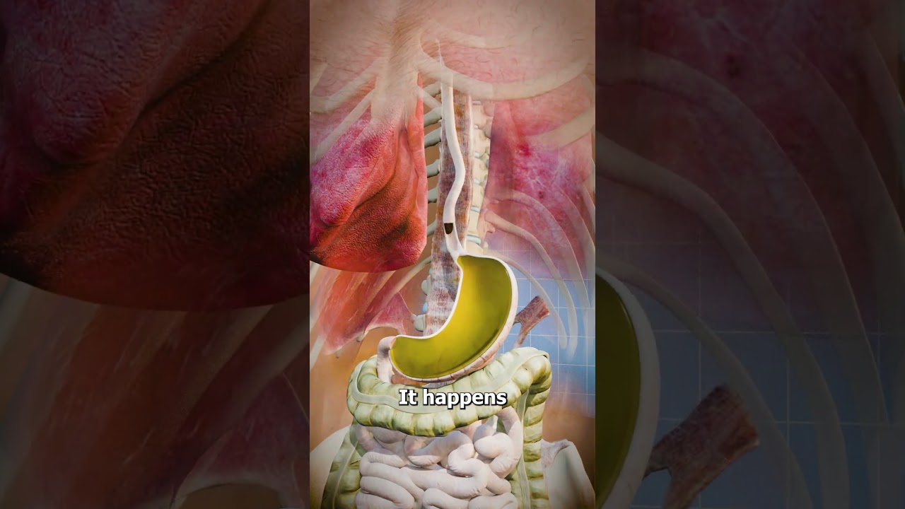 Acid Reflux Explained 🤔