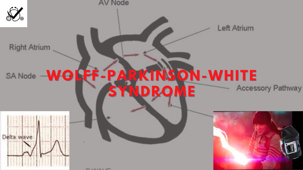 Preexcitation Syndromes: Wolff-Parkinson-White Syndrome