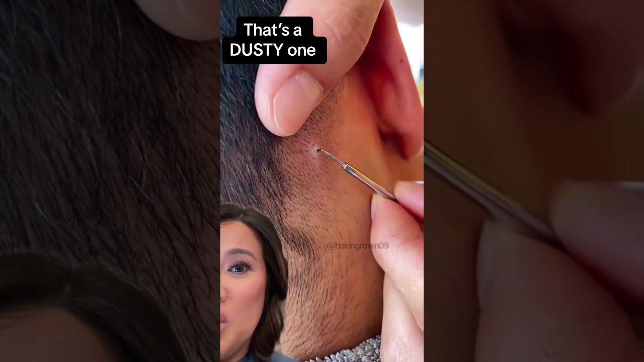 Terminal Hair in Scalp