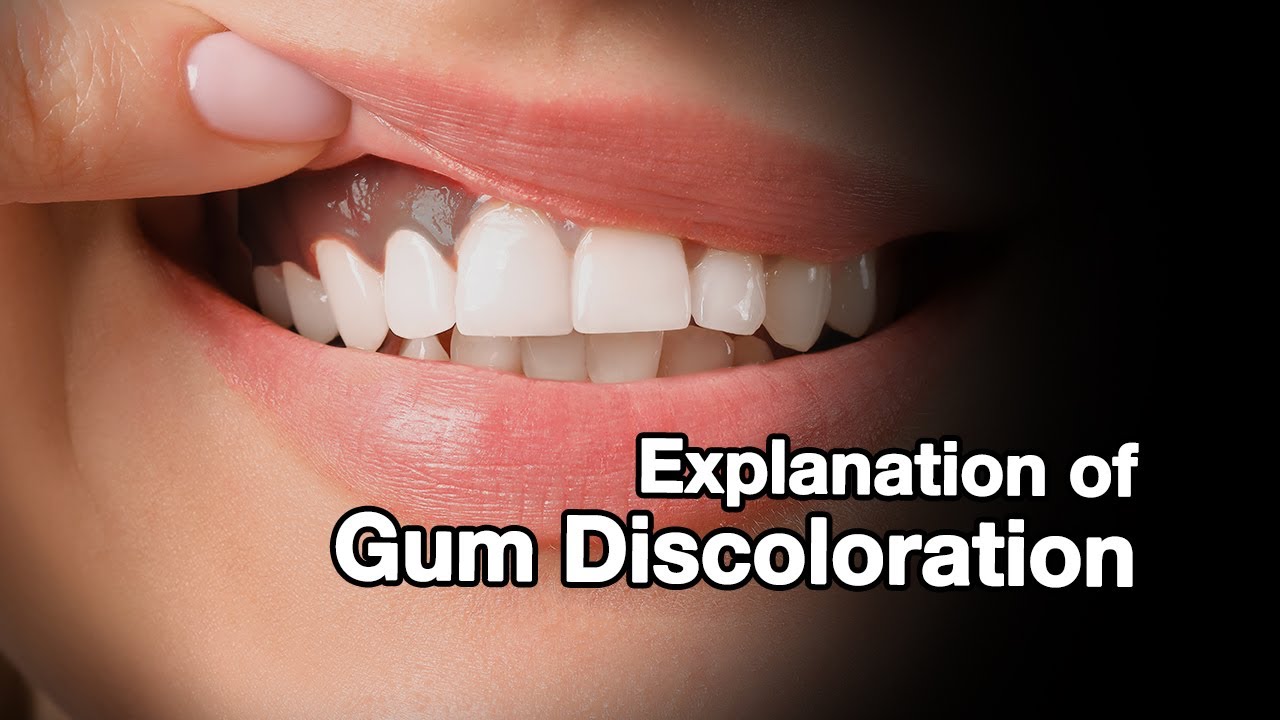 Discoloration of Gum: Causes, Symptoms, and Treatment