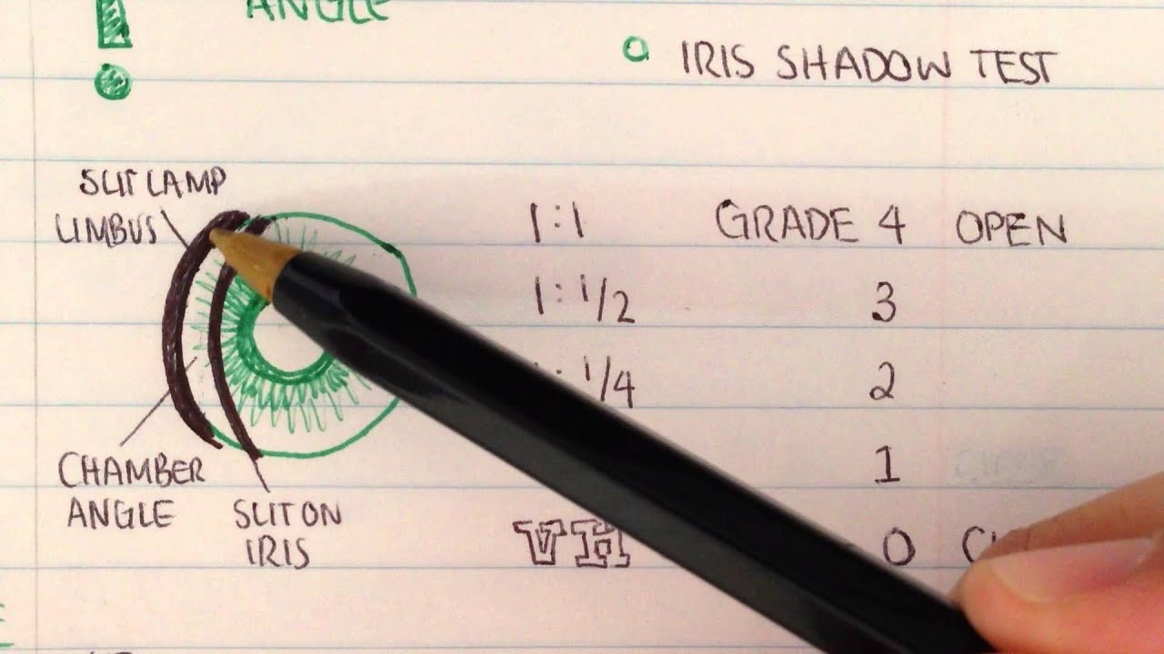 Gonioscopy- Anterior chamber assessment
